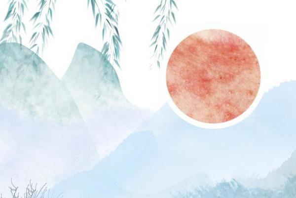 苏州哪家医院治疗银屑病有效