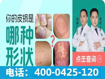 苏州哪所医院治疗银屑病好